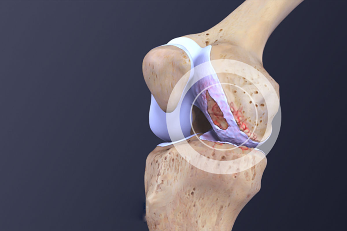 آیا پارگی مینیسک زانو خطرناک است؟