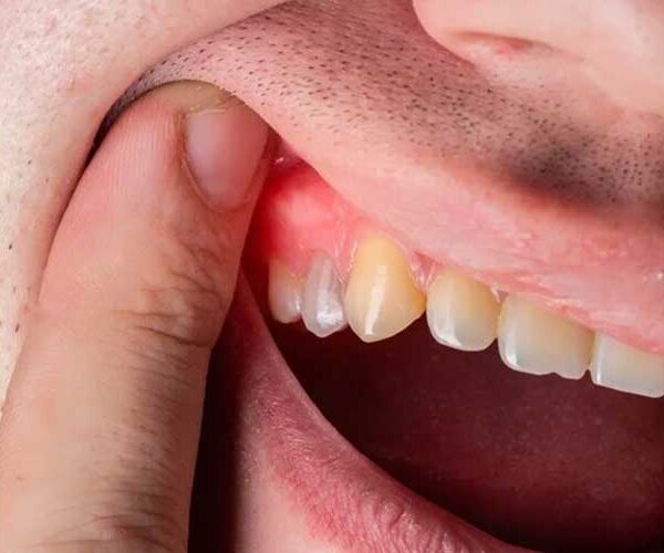 بیماری ‌های لثه، علائم و پیشگیری‌