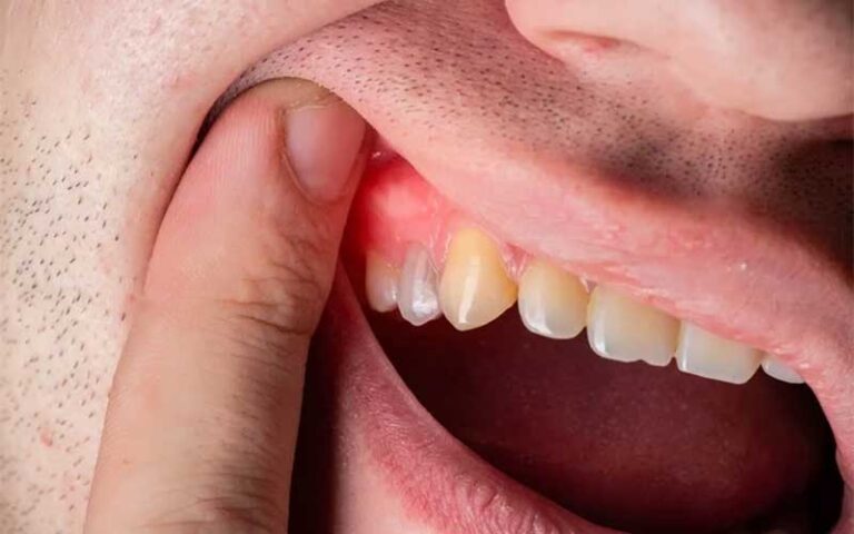 بیماری ‌های لثه، علائم و پیشگیری‌