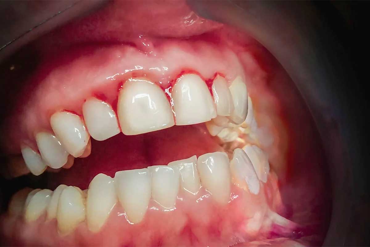 چرا لثه عفونت می‌کند؟