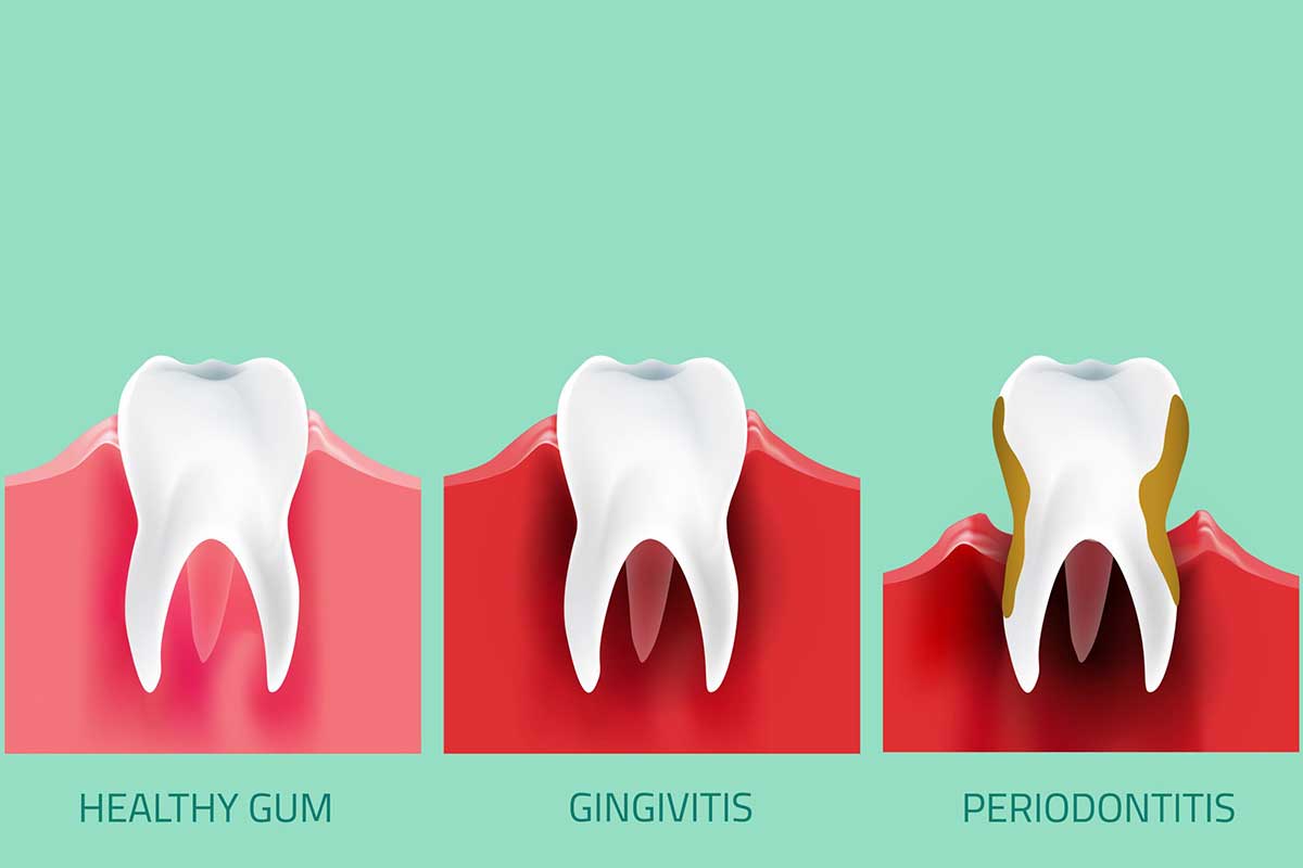 پیشرفت بیماری لثه