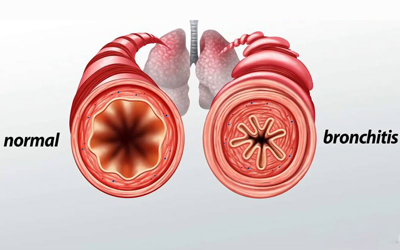 دلایل برونشیت
