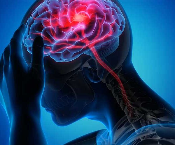 همه آنچه باید درمورد سکته مغزی بدانید