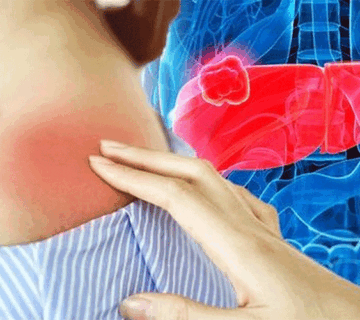 اهمیت مراقبت از پوست در بیماران کبدی