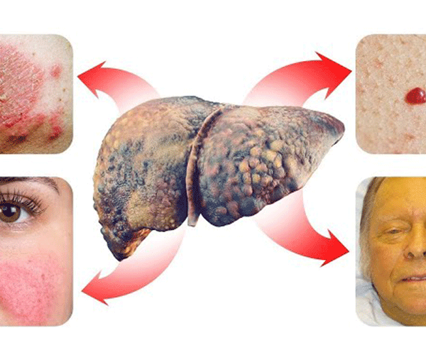 نقش کبد در بیماری های پوستی
