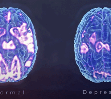 مغز افراد افسرده چه فرقی با دیگران دارد؟