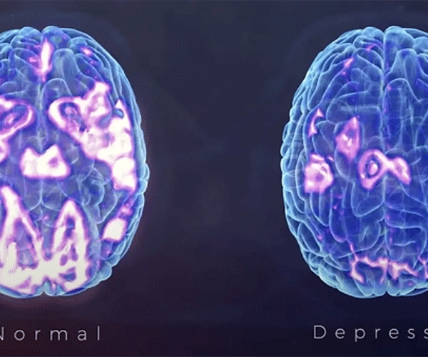 مغز افراد افسرده چه فرقی با دیگران دارد؟