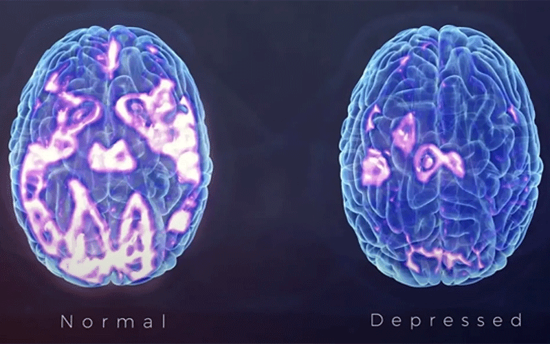 مغز افراد افسرده چه فرقی با دیگران دارد؟