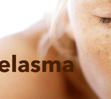 ملاسما چیست و چه کسانی در معرض ابتلا به آن هستند؟