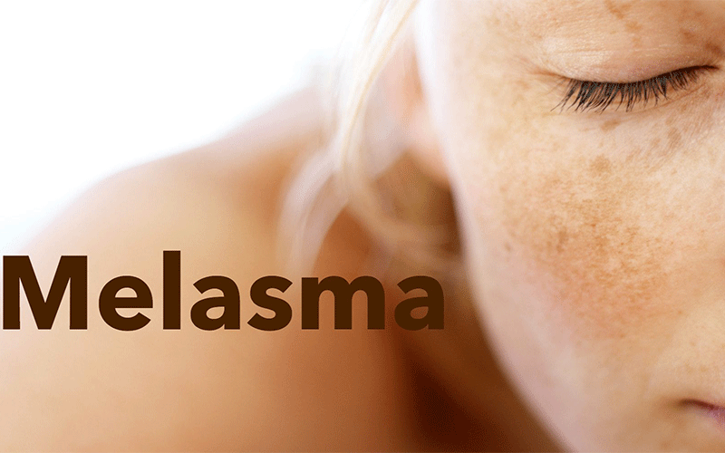 ملاسما چیست و چه کسانی در معرض ابتلا به آن هستند؟