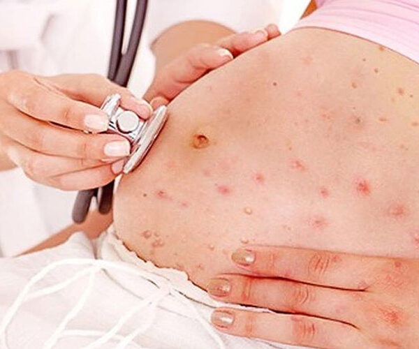 بارداری و سرخچه هر آنچه باید بدانید