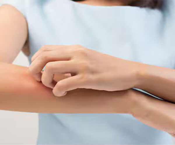 تابستان و پسوریازیس؛ چگونه در فصل گرما با آسودگی خاطر زندگی کنیم؟