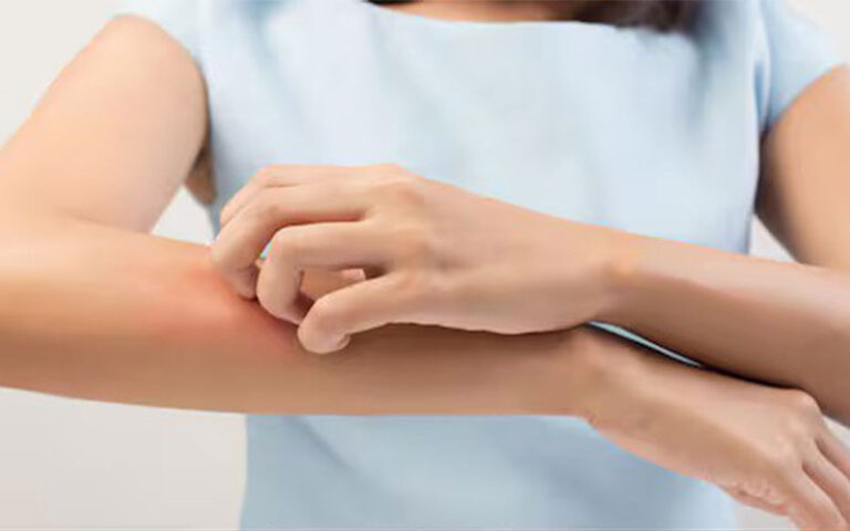 تابستان و پسوریازیس؛ چگونه در فصل گرما با آسودگی خاطر زندگی کنیم؟