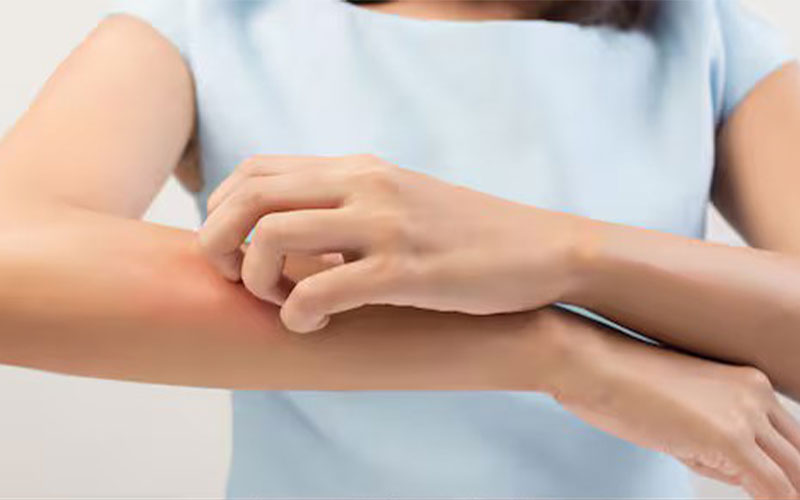 تابستان و پسوریازیس؛ چگونه در فصل گرما با آسودگی خاطر زندگی کنیم؟